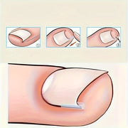 ingrown toenail 20 30 50 70 80 90 100pcs