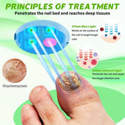 nail fungus laser device laser device fungal